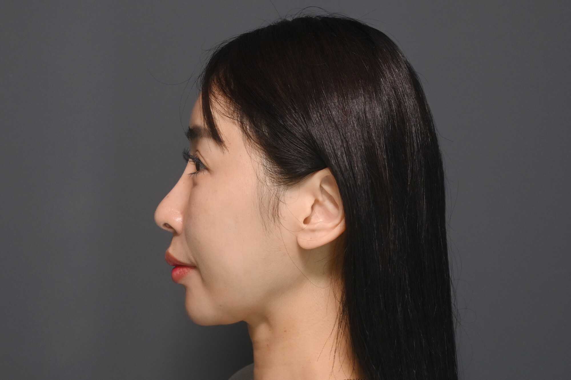 術前困擾：不再側臉閃躲，追求比例的「精緻感」｜見證案例-Angel緁希